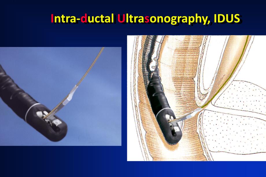 IDUS对胆胰管疾病的应用体会课件_第1页