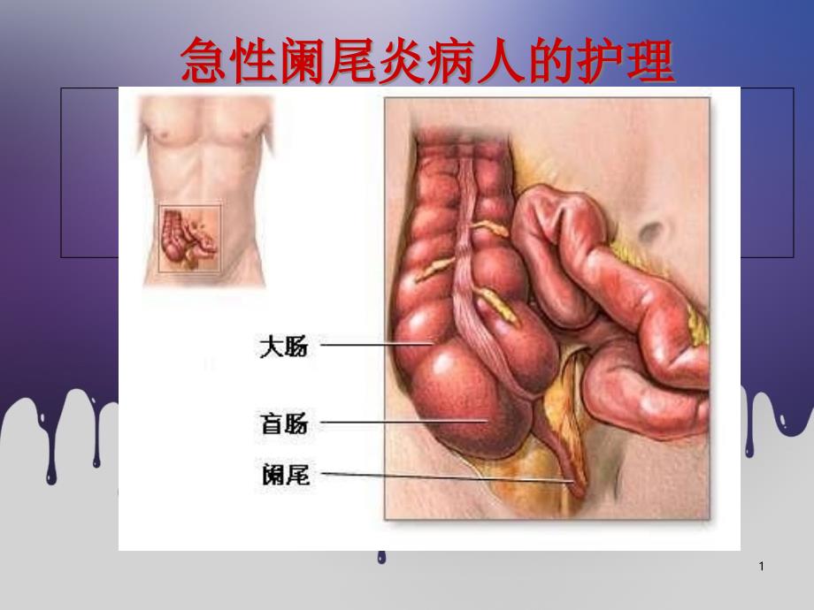 急性阑尾炎病人的护理精课件_第1页