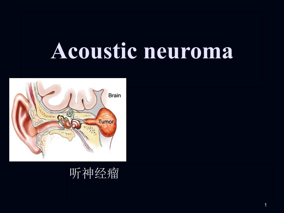 听神经瘤英文课件_第1页
