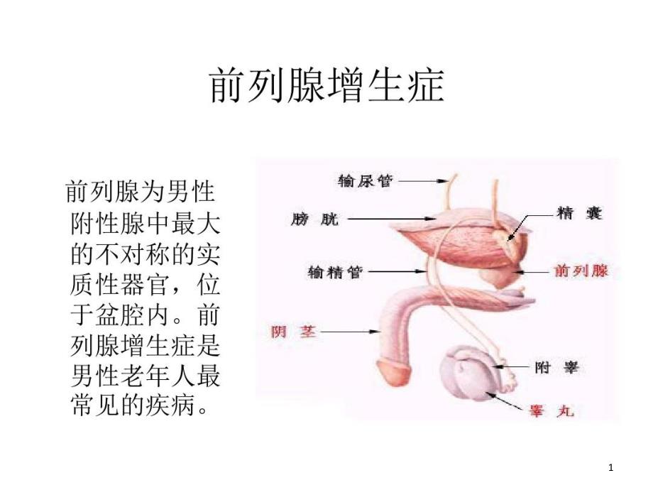 前列腺增生症ppt课件_第1页