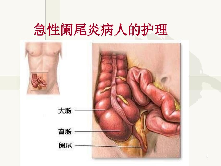 急性阑尾炎病人的护理ppt课件_第1页