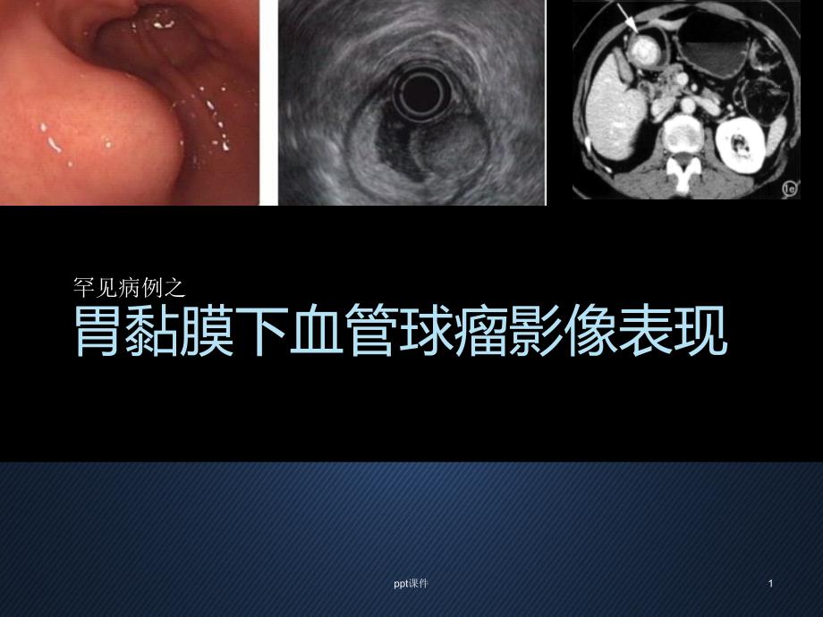 血管球瘤影像表现与鉴别诊断--课件_第1页