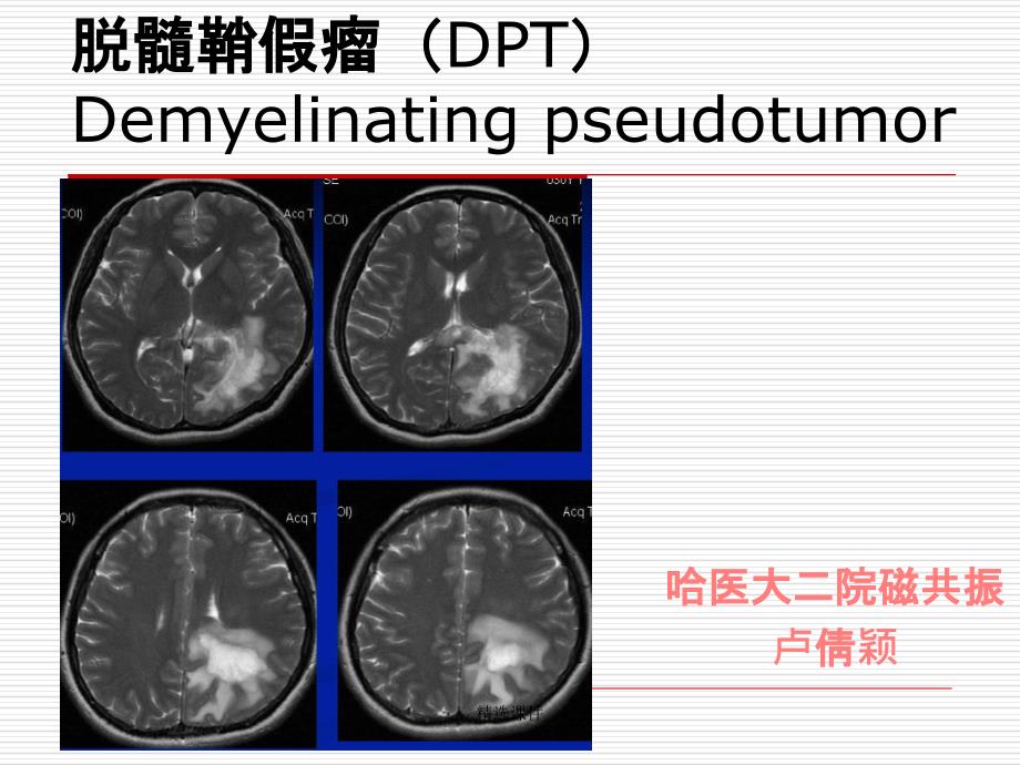 脱髓鞘假瘤MRI诊断课件_第1页