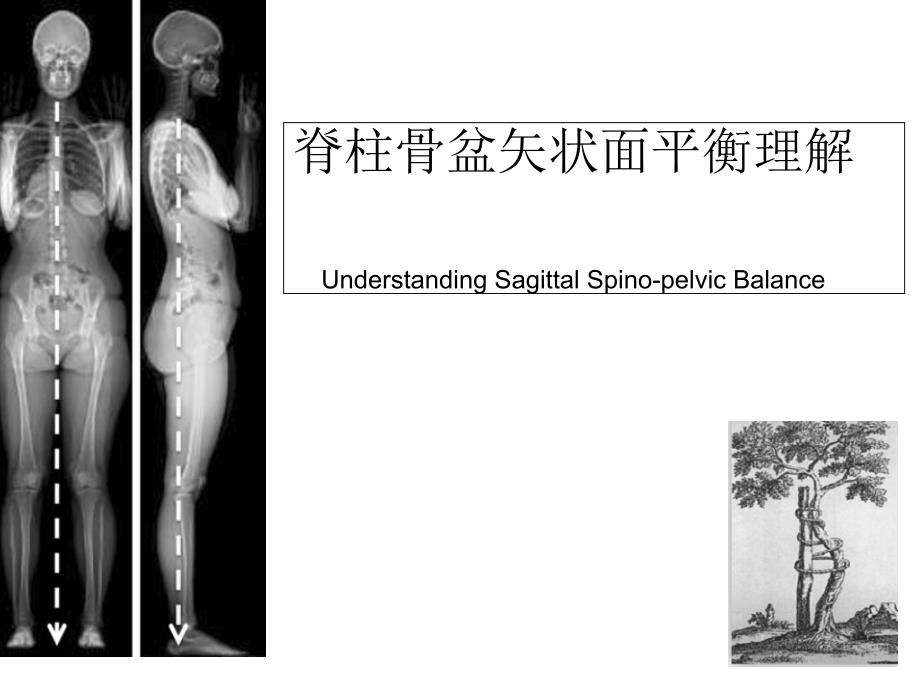 脊柱骨盆矢状面平衡理解课件_第1页