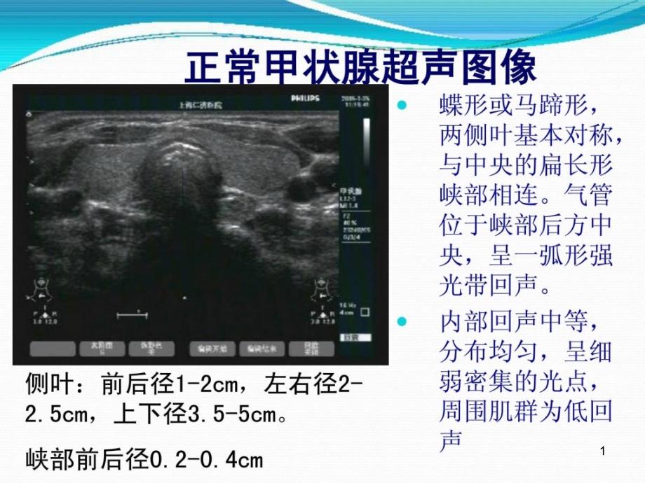 指南甲状腺疾病的超声诊断辨别课件_第1页