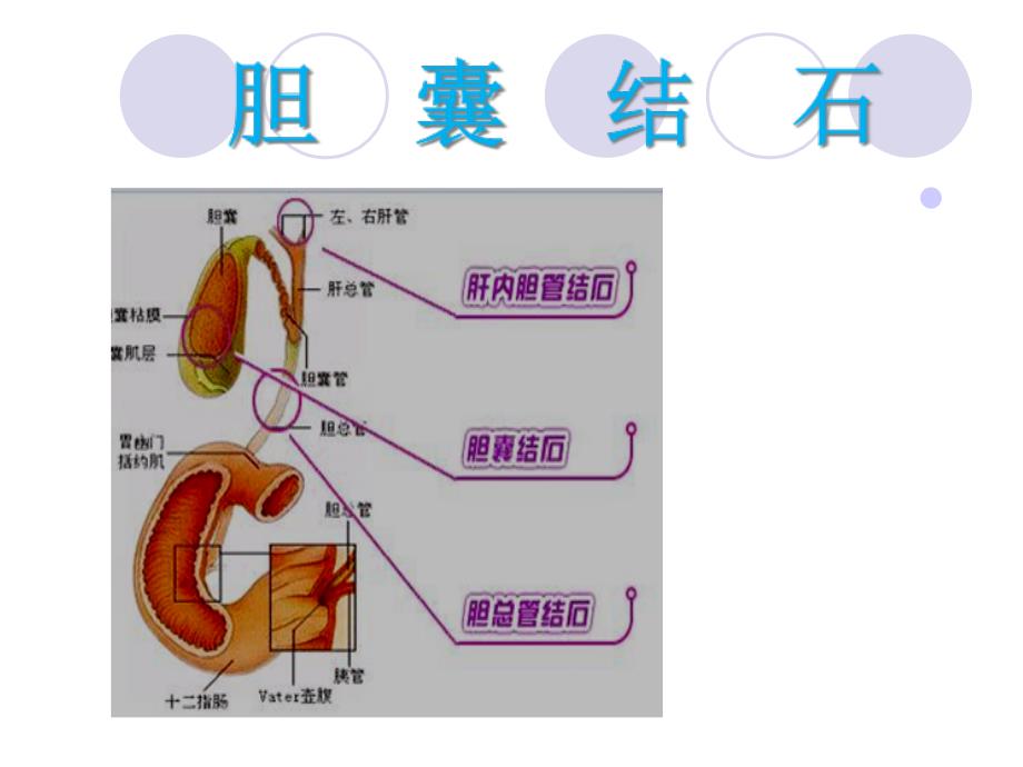 胆囊结石护理课件_第1页