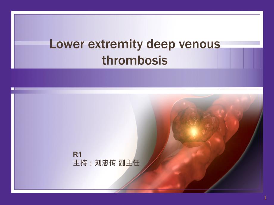 深静脉血栓DV课件_第1页