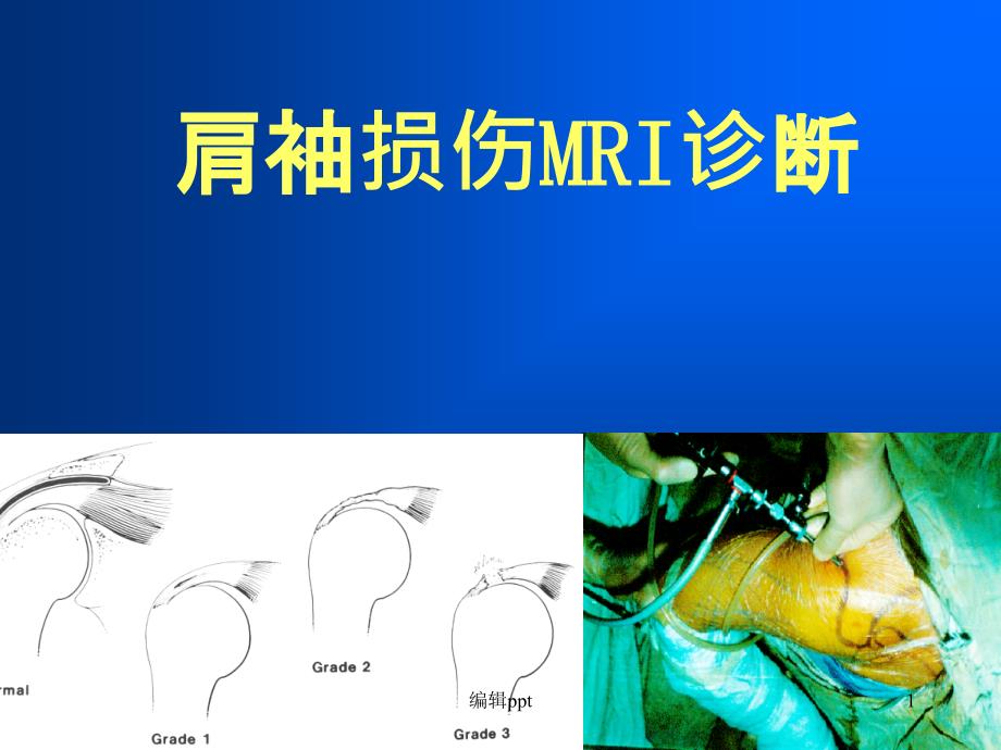 肩袖损伤MRI诊断课件_第1页