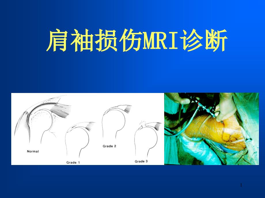 肩袖损伤MRI诊断ppt课件_第1页