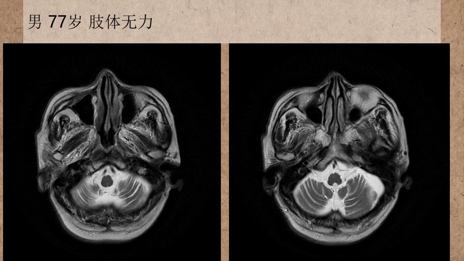 橄榄桥脑小脑萎缩的影像学诊断课件_第1页