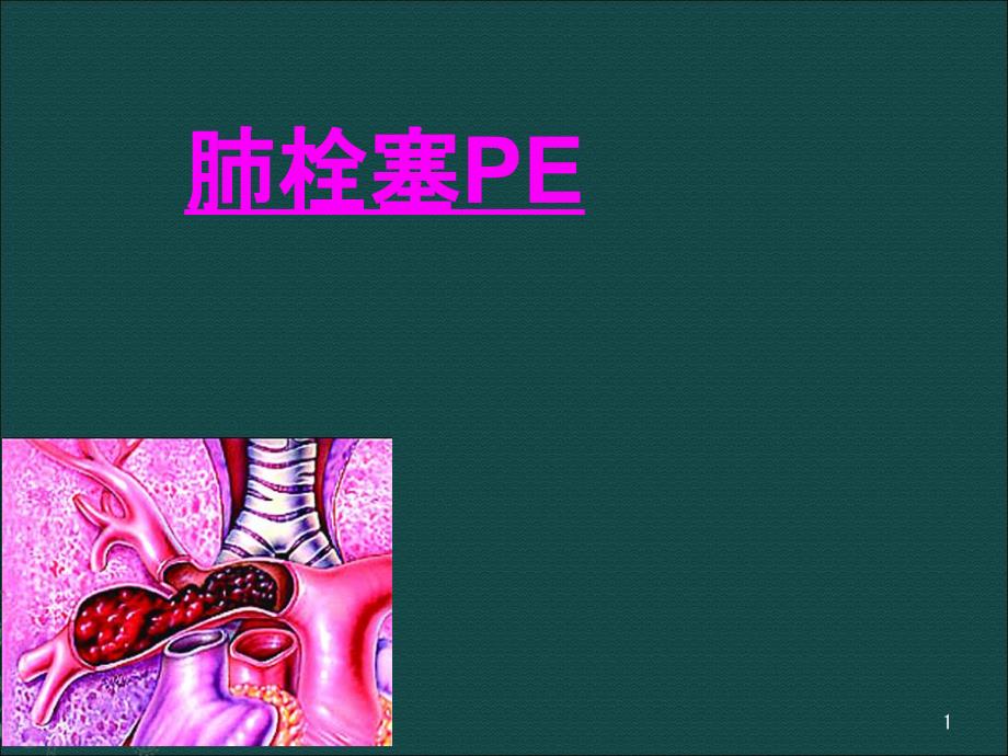 急性肺栓塞(PTE)课件_第1页