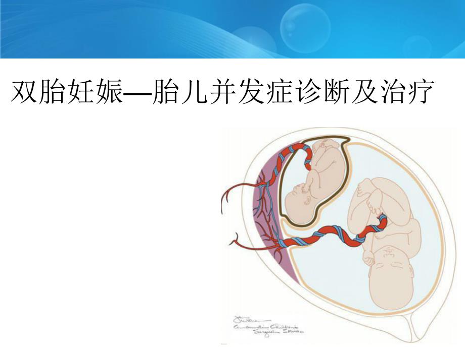 双胎妊娠特有并发症课件_第1页