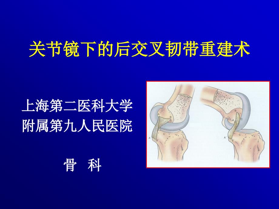 关节镜下的后交叉韧带重建术课件_第1页