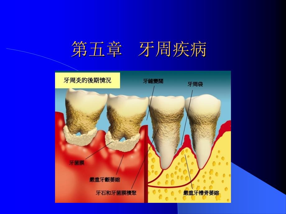 牙周组织疾病课件_第1页