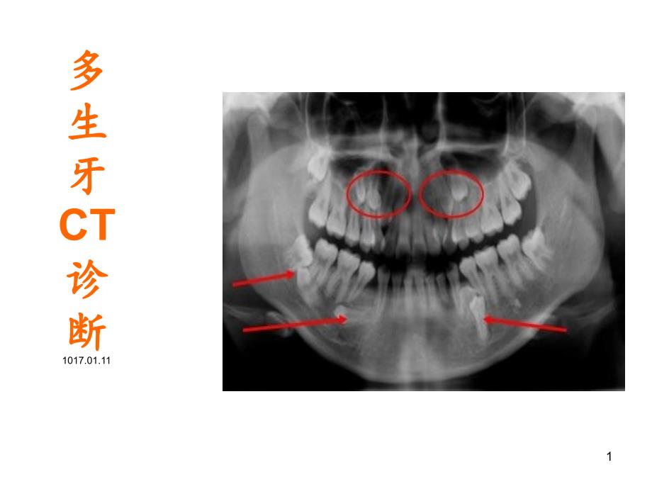 多生牙CT诊断-课件_第1页