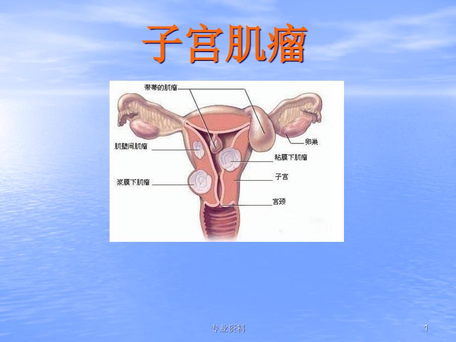 子宫肌瘤 ppt课件_第1页