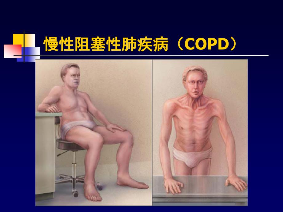 COPD一种伴有异常炎症反应的多因素构成的疾病_第1页