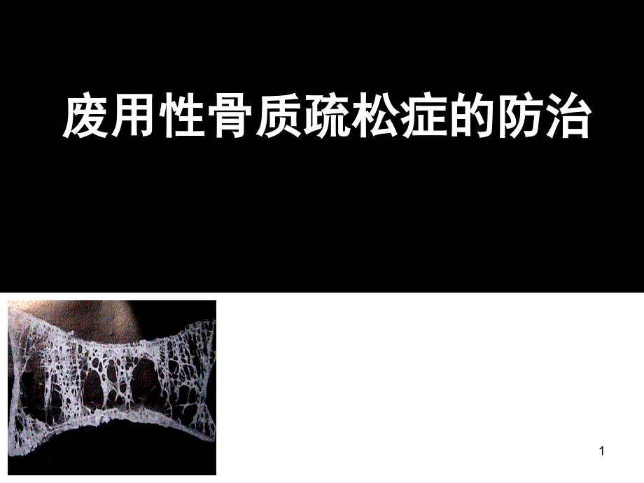 废用性骨质疏松的诊断与治疗课件_第1页